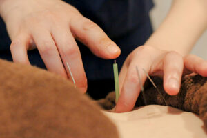 鍼灸